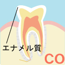 CO：むし歯の始まり